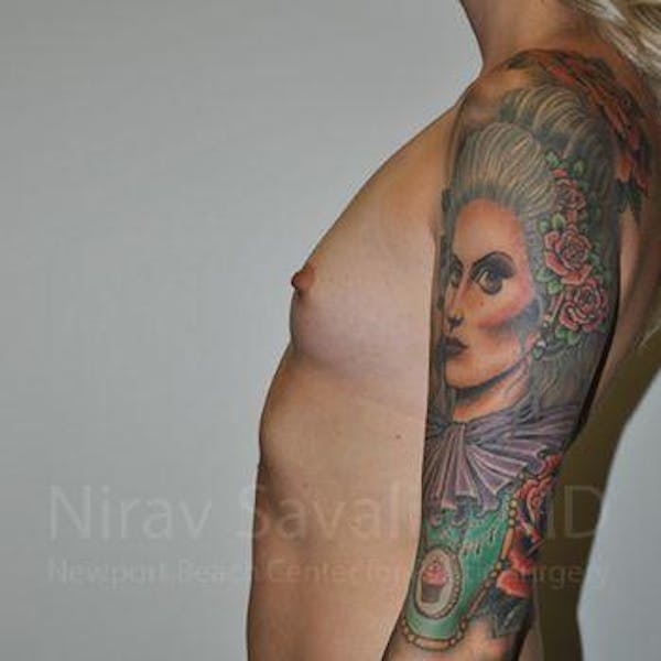 Breast Augmentation Before & After Gallery - Patient 1655595 - Image 9