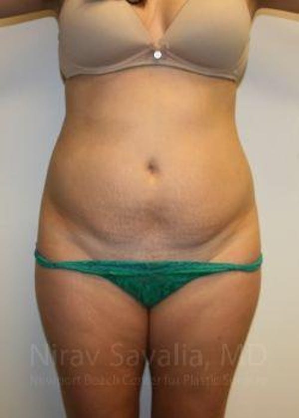 Abdominoplasty / Tummy Tuck Gallery - Patient 1655598 - Image 1