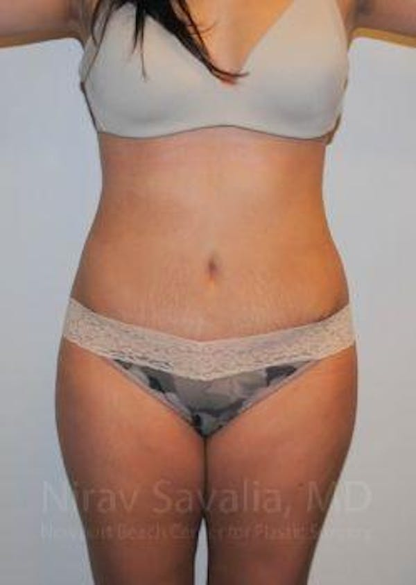 Abdominoplasty / Tummy Tuck Before & After Gallery - Patient 1655598 - Image 2