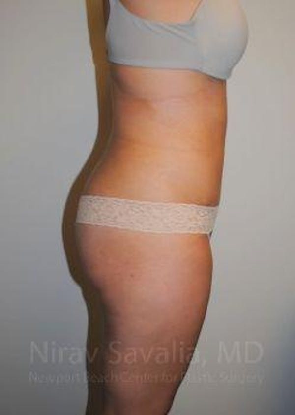 Abdominoplasty / Tummy Tuck Before & After Gallery - Patient 1655598 - Image 4