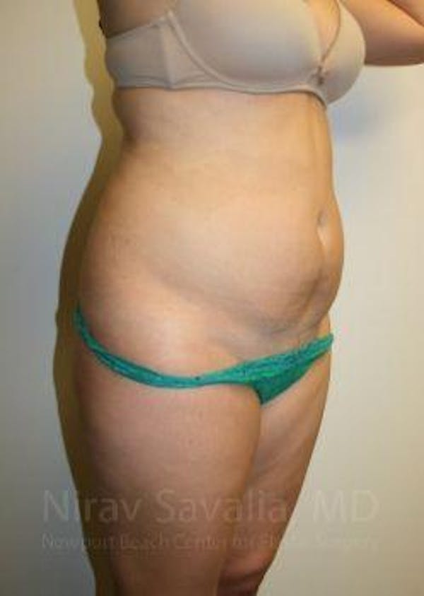 Abdominoplasty / Tummy Tuck Before & After Gallery - Patient 1655598 - Image 5