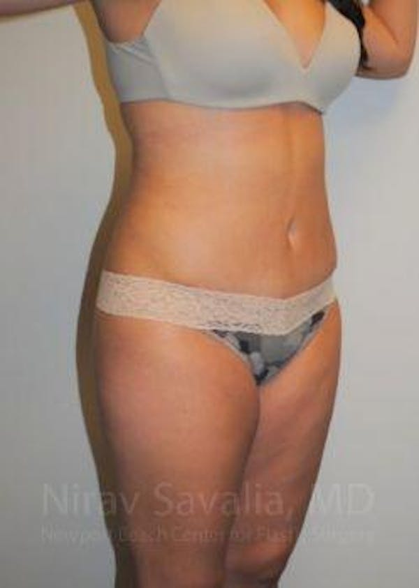 Abdominoplasty / Tummy Tuck Before & After Gallery - Patient 1655598 - Image 6