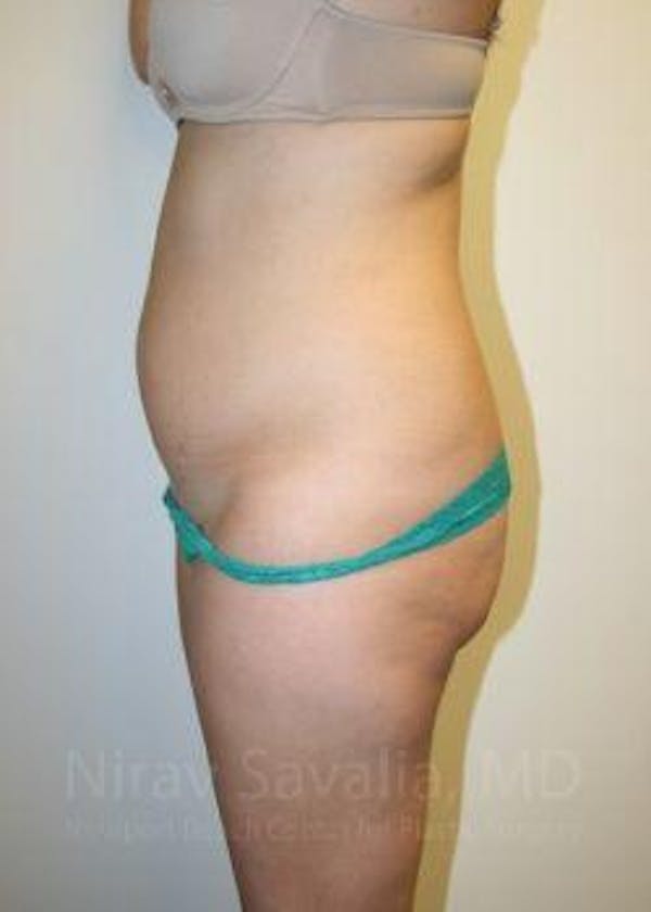 Abdominoplasty / Tummy Tuck Gallery - Patient 1655598 - Image 7