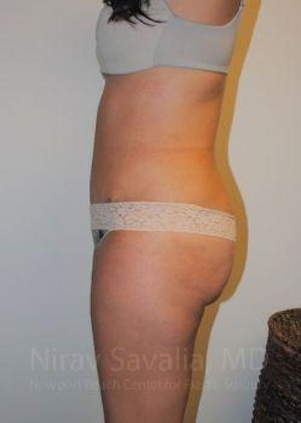Abdominoplasty / Tummy Tuck Before & After Gallery - Patient 1655598 - Image 8
