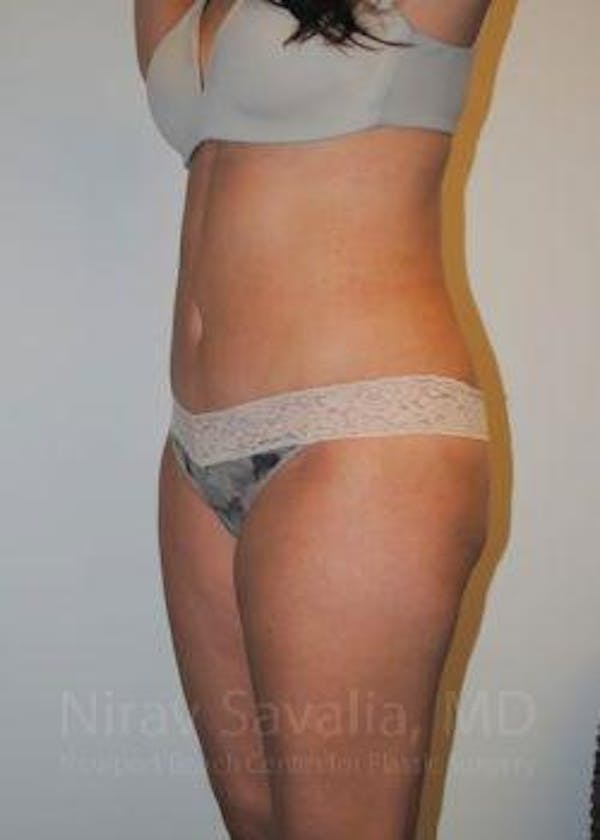 Abdominoplasty / Tummy Tuck Before & After Gallery - Patient 1655598 - Image 10