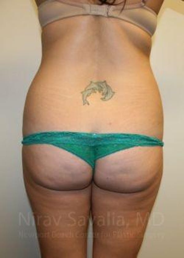 Abdominoplasty / Tummy Tuck Before & After Gallery - Patient 1655598 - Image 11