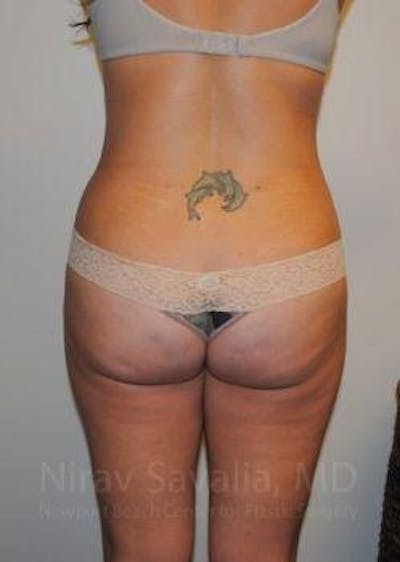 Abdominoplasty / Tummy Tuck Before & After Gallery - Patient 1655598 - Image 12