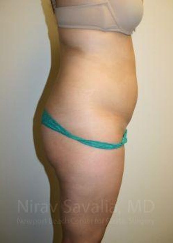Liposuction Before & After Gallery - Patient 1655599 - Image 3