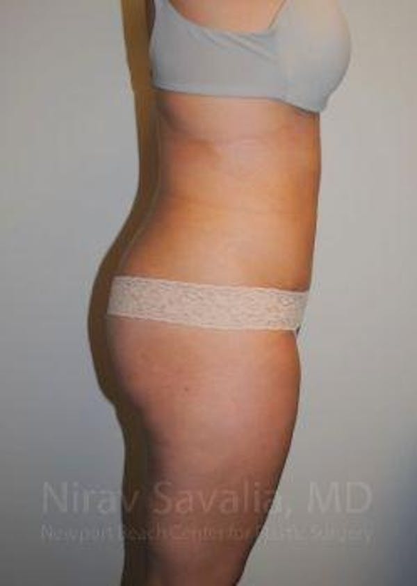 Liposuction Before & After Gallery - Patient 1655599 - Image 4