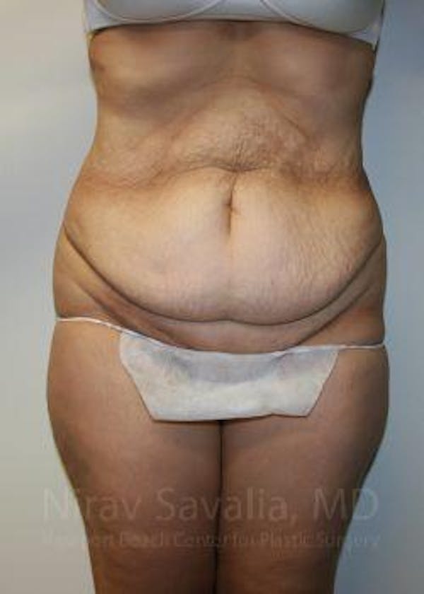 Abdominoplasty / Tummy Tuck Before & After Gallery - Patient 1655601 - Image 1