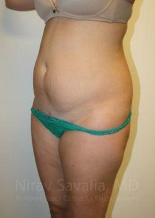 Liposuction Before & After Gallery - Patient 1655599 - Image 9