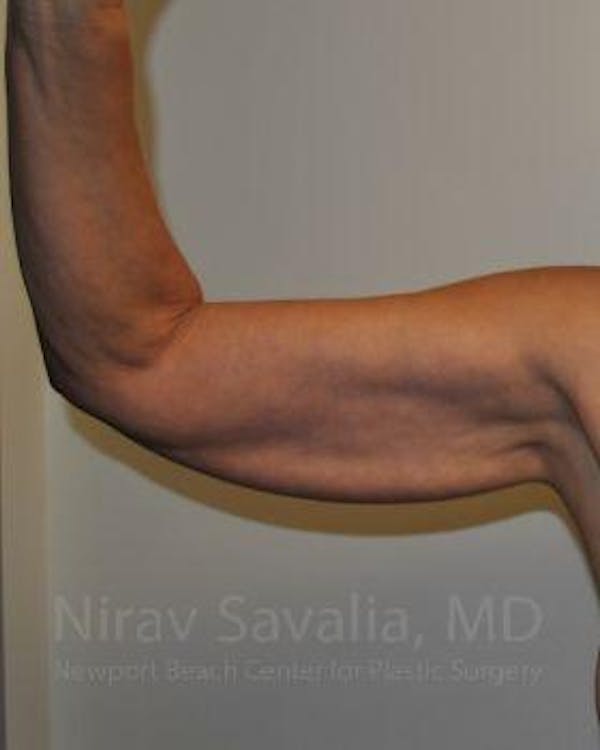 Arm Lift Before & After Gallery - Patient 1655600 - Image 1