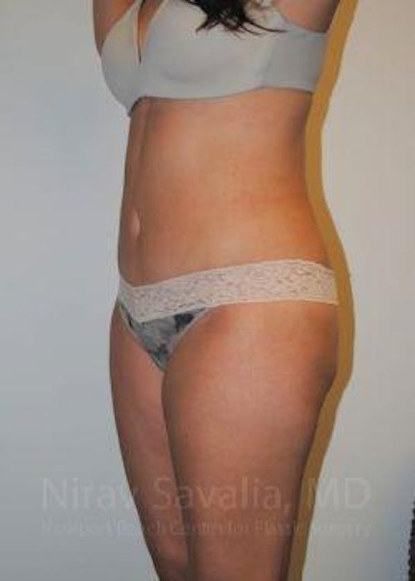 Liposuction Before & After Gallery - Patient 1655599 - Image 10