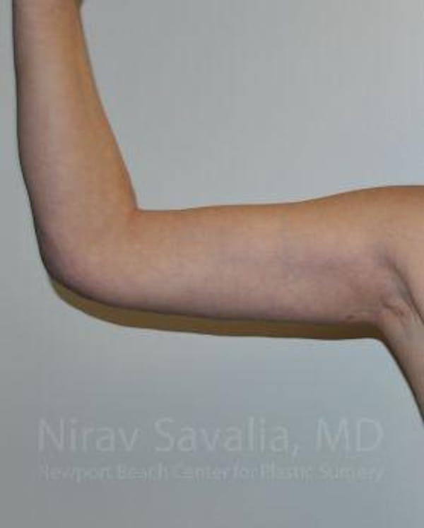 Arm Lift Before & After Gallery - Patient 1655600 - Image 2