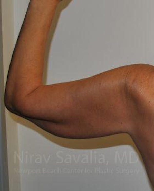 Arm Lift Before & After Gallery - Patient 1655600 - Image 3