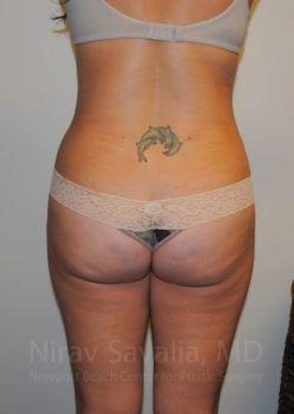Liposuction Before & After Gallery - Patient 1655599 - Image 12