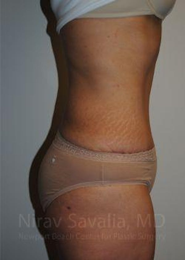Abdominoplasty / Tummy Tuck Before & After Gallery - Patient 1655601 - Image 4