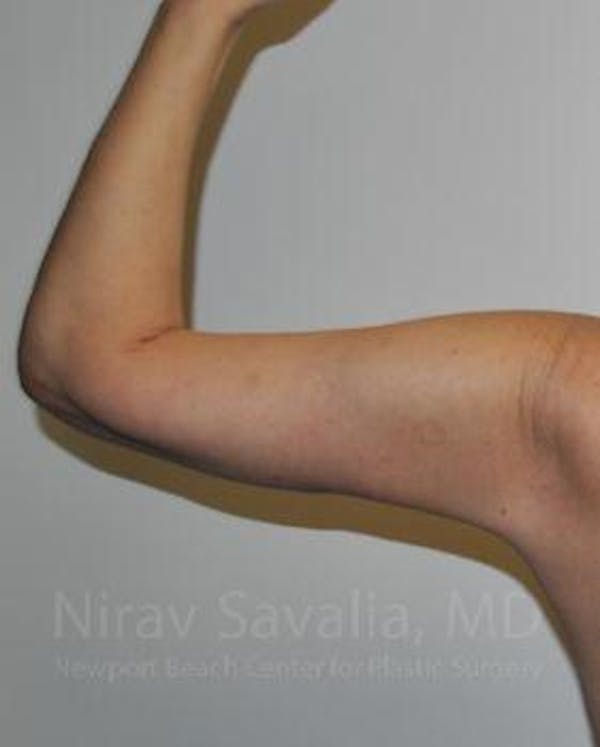 Arm Lift Before & After Gallery - Patient 1655600 - Image 4