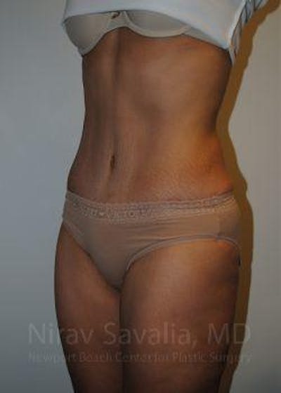 Abdominoplasty / Tummy Tuck Before & After Gallery - Patient 1655601 - Image 8