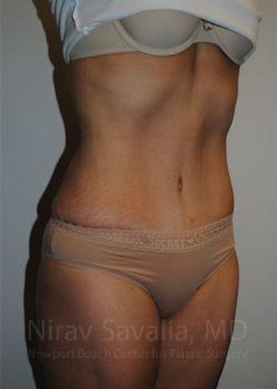 Abdominoplasty / Tummy Tuck Gallery - Patient 1655601 - Image 10