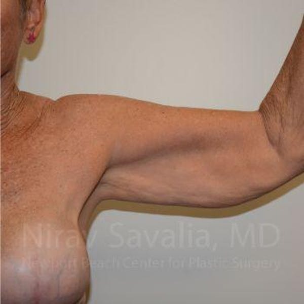 Arm Lift Before & After Gallery - Patient 1655602 - Image 3