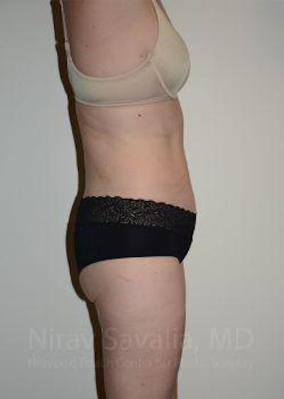 Liposuction Gallery - Patient 1655603 - Image 4