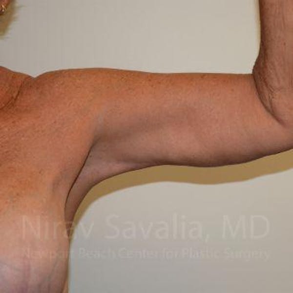 Arm Lift Before & After Gallery - Patient 1655602 - Image 4