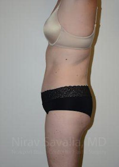 Liposuction Before & After Gallery - Patient 1655603 - Image 6