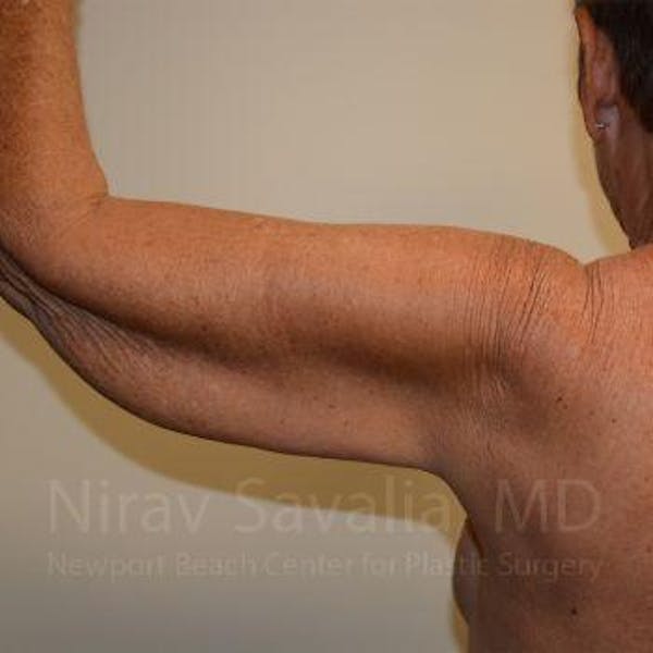 Arm Lift Before & After Gallery - Patient 1655602 - Image 5