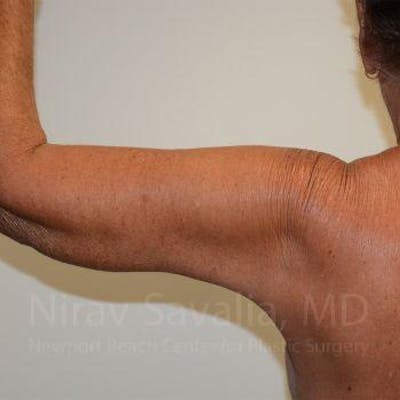 Arm Lift Before & After Gallery - Patient 1655602 - Image 6