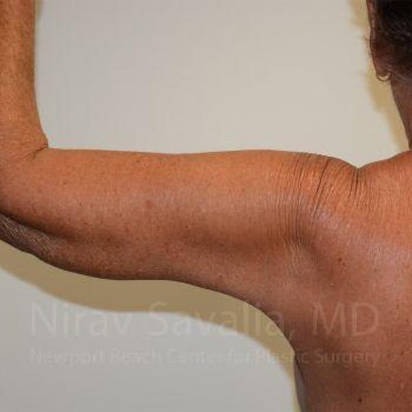 Arm Lift Before & After Gallery - Patient 1655602 - Image 6