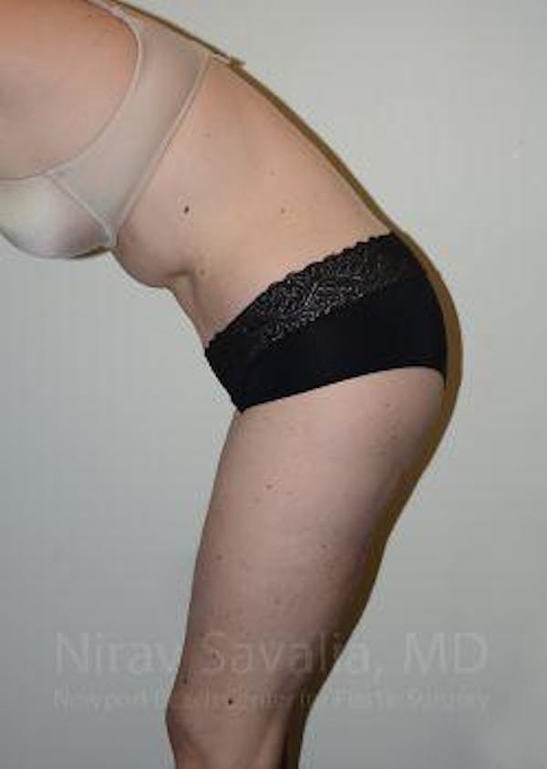 Liposuction Before & After Gallery - Patient 1655603 - Image 8