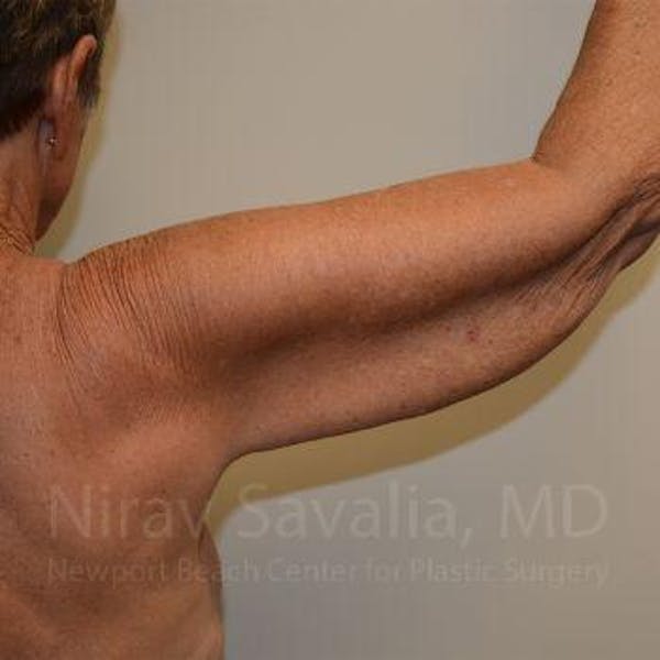 Arm Lift Before & After Gallery - Patient 1655602 - Image 7
