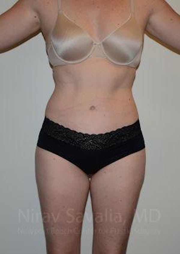 Abdominoplasty / Tummy Tuck Before & After Gallery - Patient 1655605 - Image 2