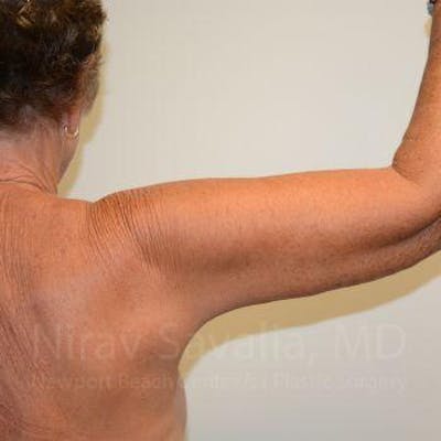 Arm Lift Before & After Gallery - Patient 1655602 - Image 8