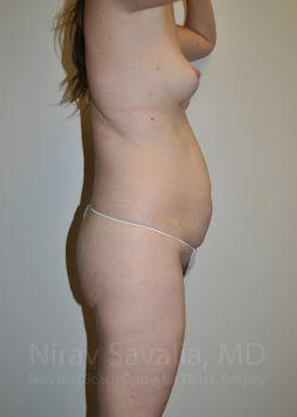 Abdominoplasty / Tummy Tuck Before & After Gallery - Patient 1655605 - Image 3