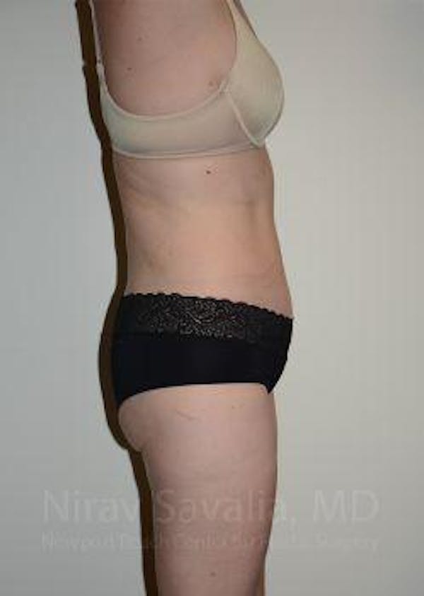 Abdominoplasty / Tummy Tuck Before & After Gallery - Patient 1655605 - Image 4