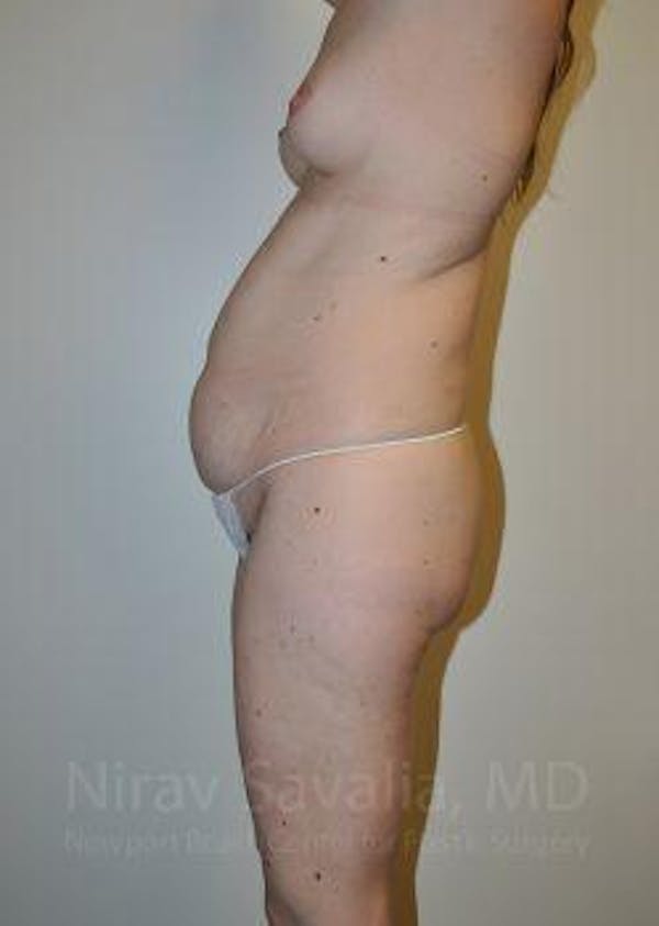 Abdominoplasty / Tummy Tuck Before & After Gallery - Patient 1655605 - Image 5