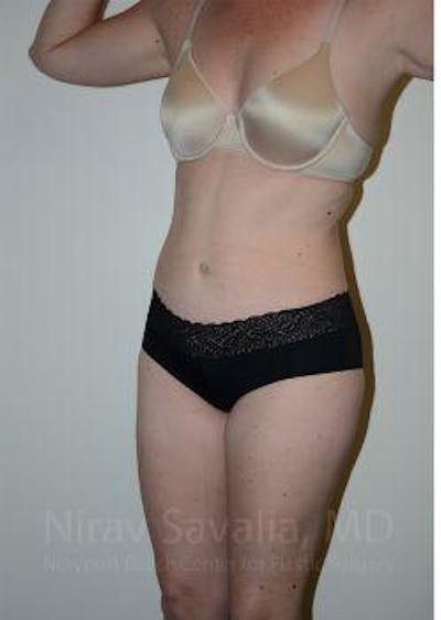 Liposuction Before & After Gallery - Patient 1655603 - Image 12