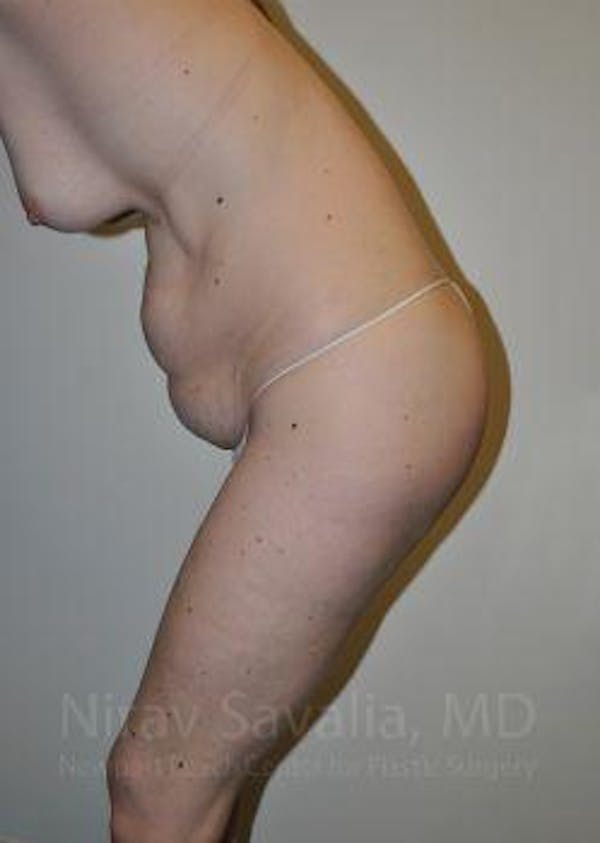 Abdominoplasty / Tummy Tuck Gallery - Patient 1655605 - Image 7