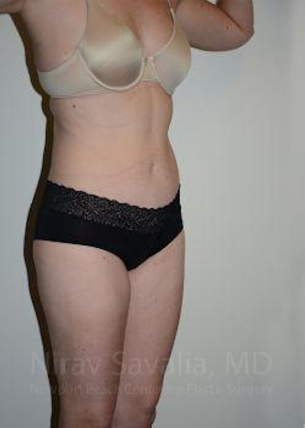 Abdominoplasty / Tummy Tuck Before & After Gallery - Patient 1655605 - Image 10