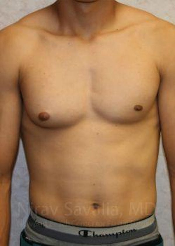 Male Breast Reduction Gallery - Patient 1655607 - Image 1