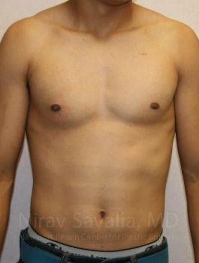Male Breast Reduction Before & After Gallery - Patient 1655607 - Image 2