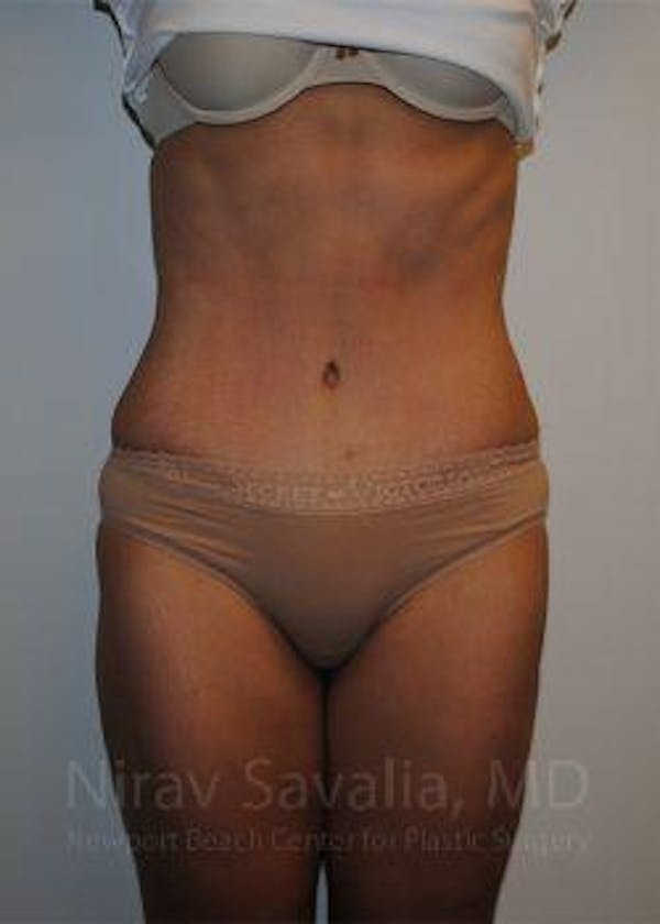 Liposuction Gallery - Patient 1655608 - Image 2