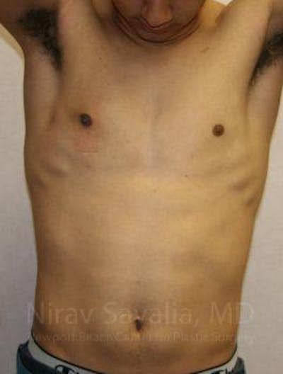 Male Breast Reduction Before & After Gallery - Patient 1655607 - Image 4