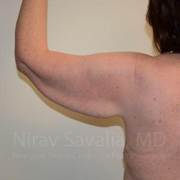 Arm Lift Before & After Gallery - Patient 1655606 - Image 7