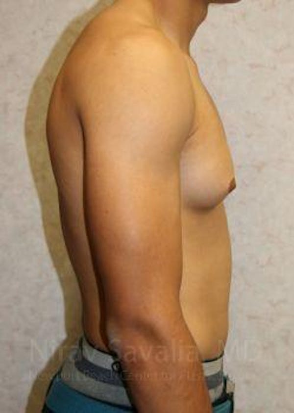 Male Breast Reduction Before & After Gallery - Patient 1655607 - Image 5
