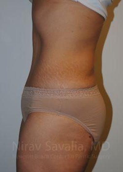 Liposuction Before & After Gallery - Patient 1655608 - Image 6