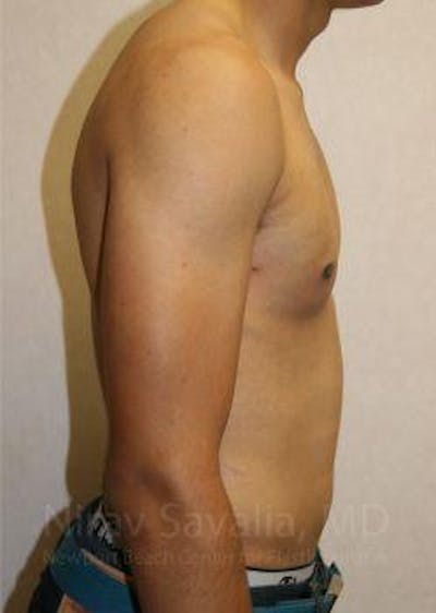 Male Breast Reduction Before & After Gallery - Patient 1655607 - Image 6