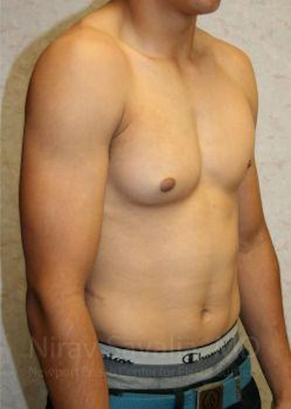 Male Breast Reduction Before & After Gallery - Patient 1655607 - Image 7